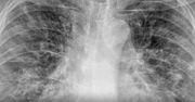 Zmiany w płucach po COVID-19. Dramatyczne zdjęcia RTG
