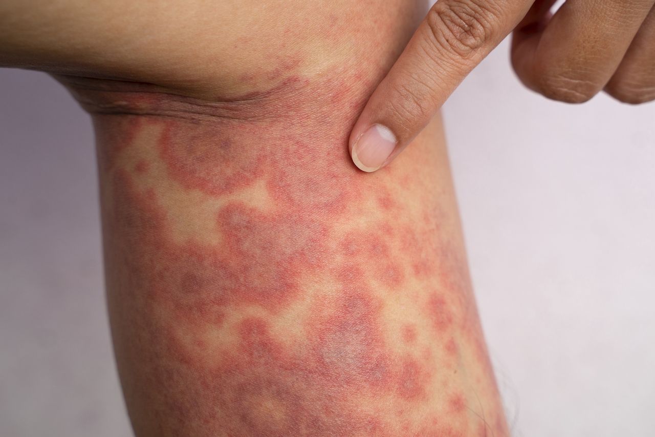 Pelagra causes skin symptoms.