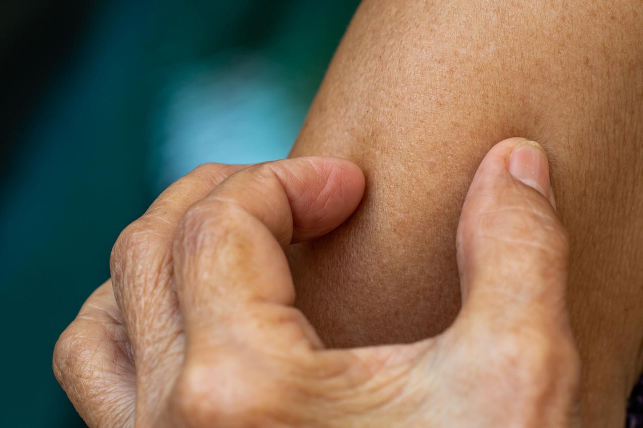 Miała nietypowy objaw nowotworu płuc. Kobieta zmarła miesiąc po rozpoznaniu choroby