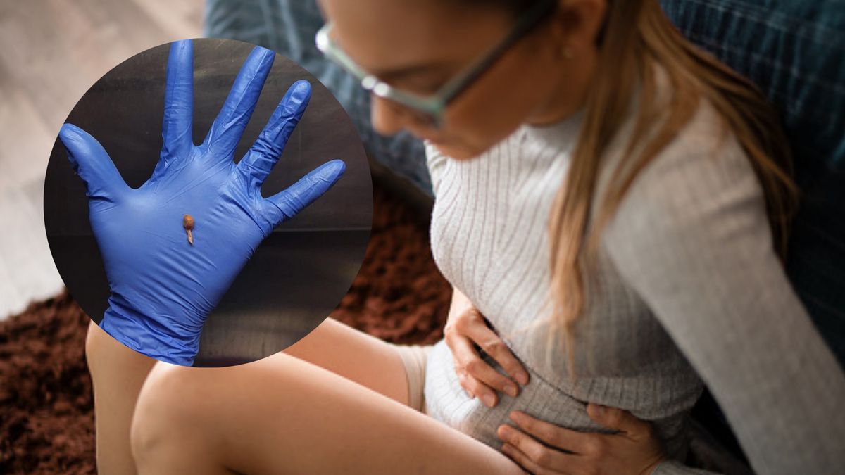 Polip jelita grubego może przekształcić się w nowotwór