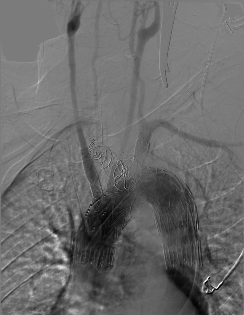 Operacja Stentografu SPSK4