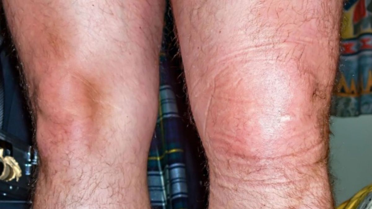 Objawem chorej wątroby może być opuchlizna