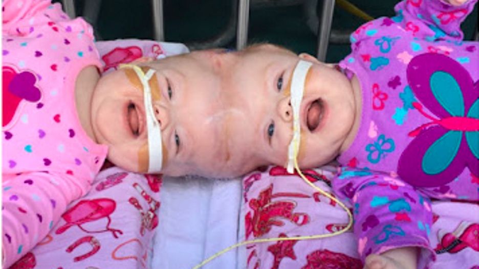 Urodziły się jako bliźniaczki syjamskie