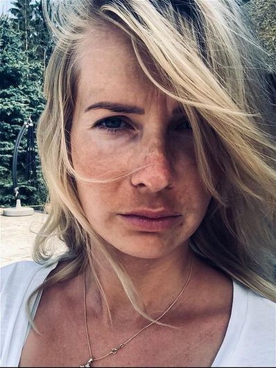 Edyta Pazura pokazuje przebarwienia na twarzy