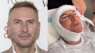 TYLKO NA PUDELKU: Krzysztof Gojdź zafundował sobie lifting za 150 tysięcy złotych! "Jestem z Hollywood. U nas liftingi są normą"