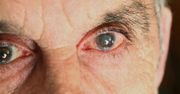 Podstępna choroba atakuje Polaków. "Jedna z głównych przyczyn ślepoty"