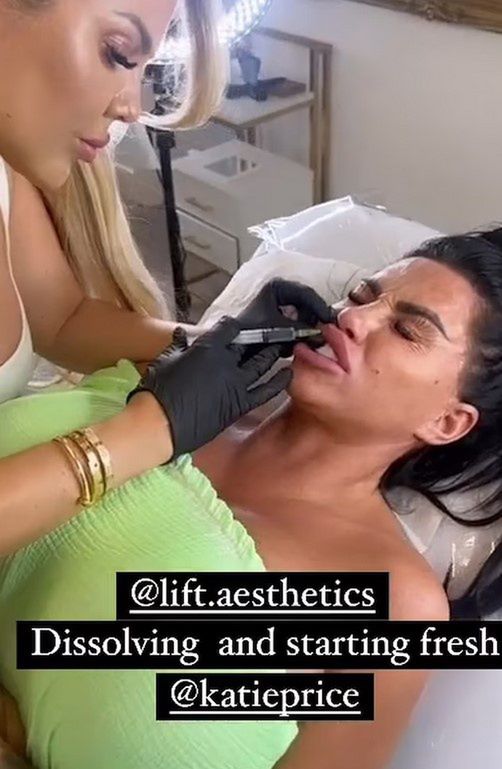 Katie Price zdecydowała się na hialuronidazę
