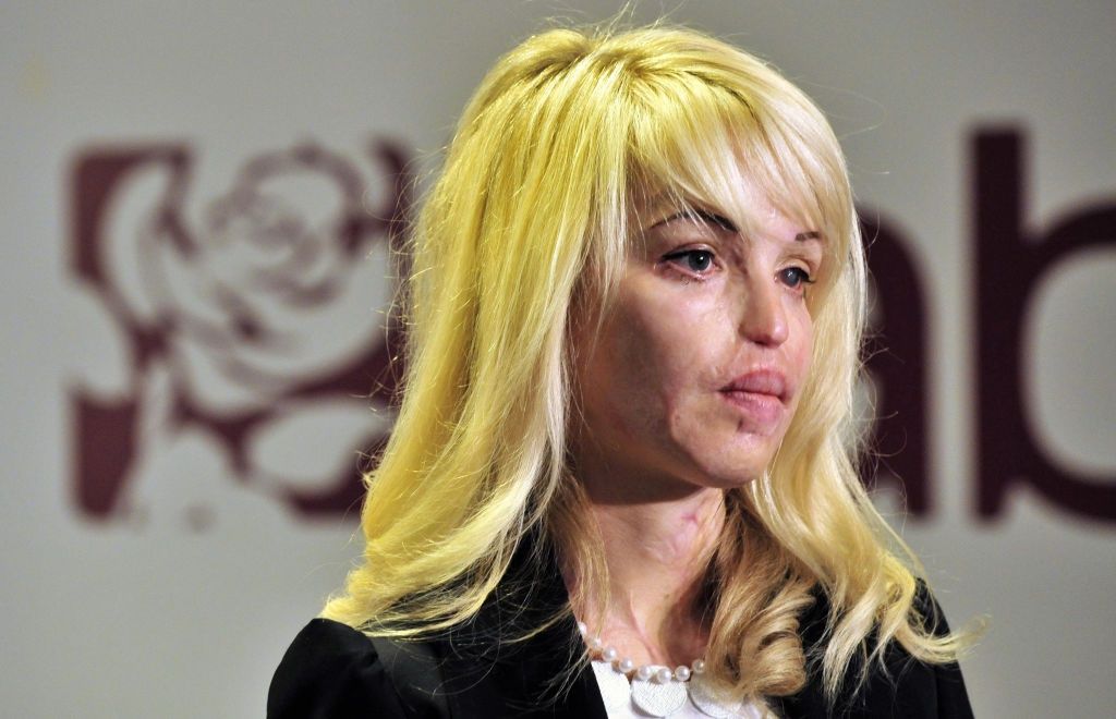 Katie Piper przeszła 400 operacji. Tak wygląda dziś