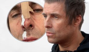 Liam Gallagher wypadł z helikoptera? Pokazał obrażenia