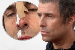 Liam Gallagher wypadł z helikoptera? Pokazał obrażenia