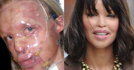 Katie Piper: "Odzyskałam twarz!"
