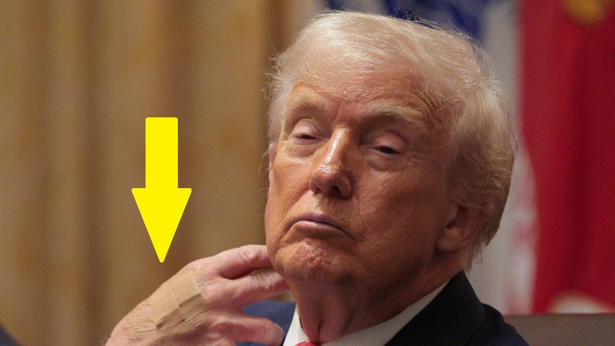 Plaster na dłoni Donalda Trumpa.