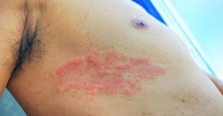 Wybuch epidemii małpiej osoby w Europie. Polacy lubią spędzać urlop w tym kraju