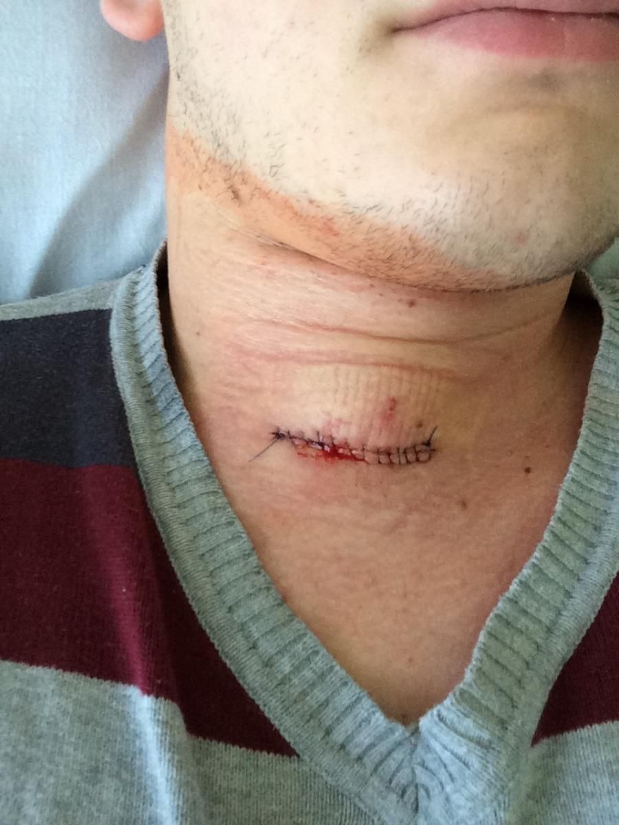 Mateusz Strelau po operacji