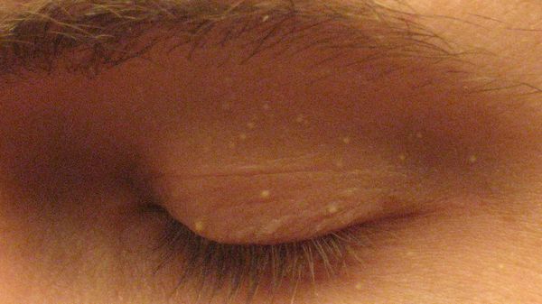 Prosaki to małe grudki o wielkości 1-2 mm. Często występują w okolicach oczu