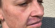 Kobietę skusił tani zabieg wypełniania ust. Jej twarz wyglądała, jak po wypadku samochodowym