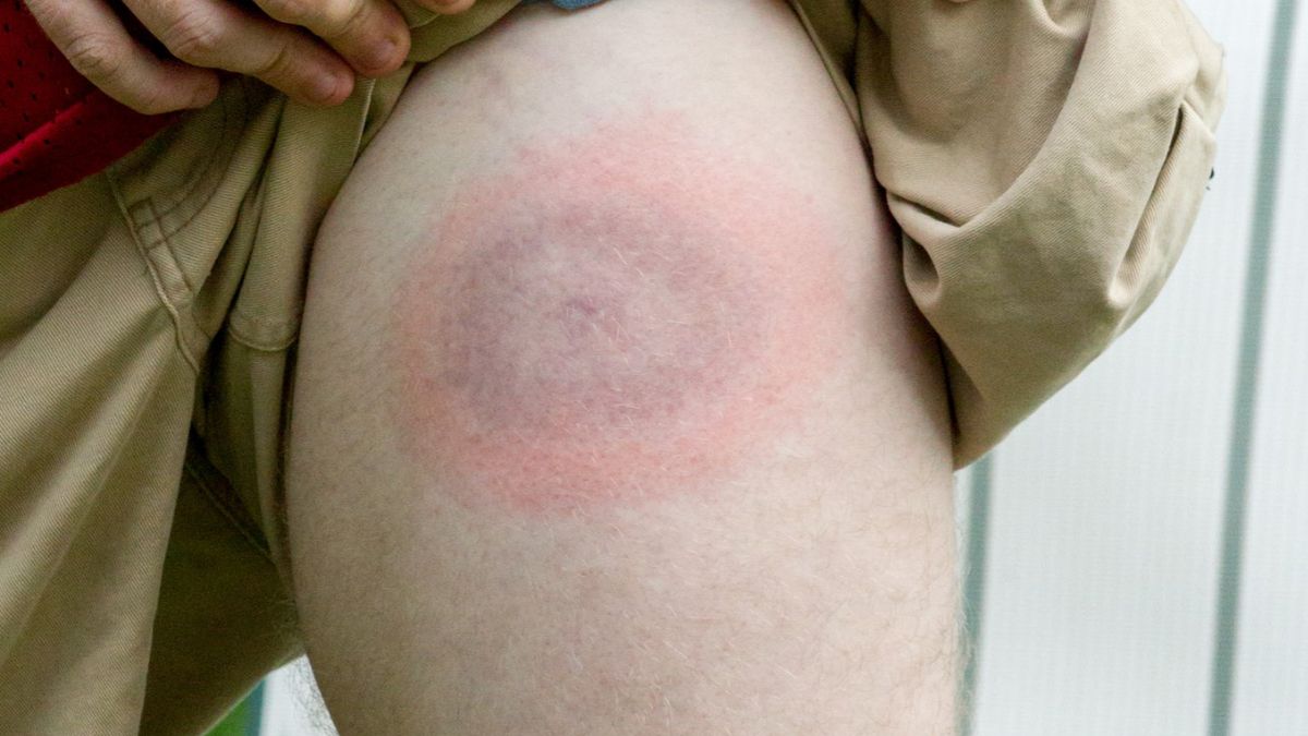 Rumień wędrujący jest charakterystycznym objawem boreliozy.