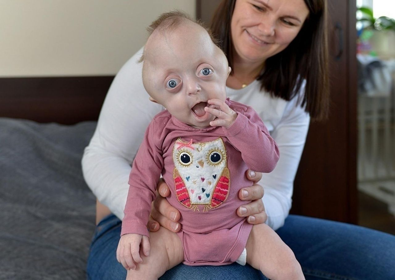 6-miesięczna Hania Krakowska cierpi na rzadką chorobę Crouzona/Pfeiffera. "Z taką chorobą rodzi się jedno na milion istnień"