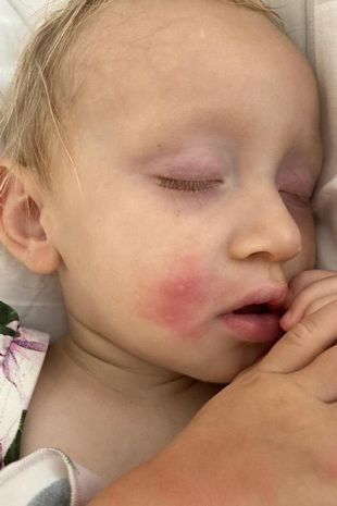 Ugryzienia pluskiew u dzieci