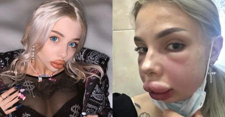 Rosyjska influencerka chciała zmniejszyć usta. Przez błąd kosmetologa SPUCHŁA i otarła się o śmierć