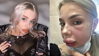 Rosyjska influencerka chciała zmniejszyć usta. Przez błąd kosmetologa SPUCHŁA i otarła się o śmierć