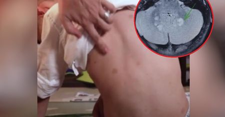 Myśleli, że to alergia na jajka. To odkryli w jego mózgu