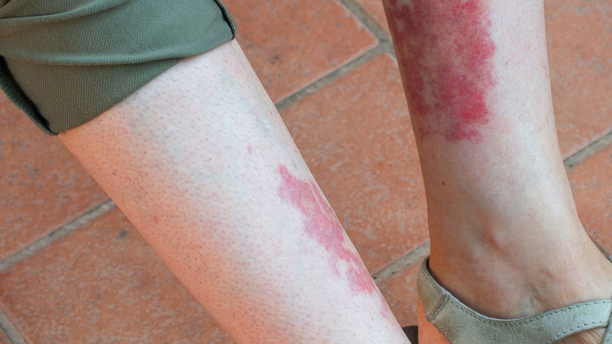 Róża to zapalna choroba skóry i tkanki podskórnej.