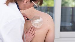 Lek, który może zwiększać ryzyko raka skóry. Nowe badania