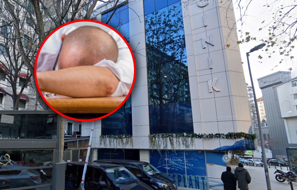 Tragiczny finał przeszczepu włosów w Turcji. "Stan się pogorszył"