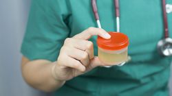 Białko Bence'a-Jonesa w moczu