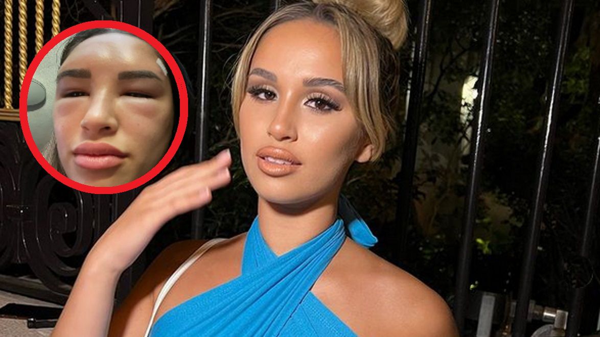 21-latkę oszpecił zabieg medycyny estetycznej