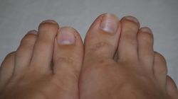 Masz takie paznokcie? Nie ignoruj, to może oznaczać, że cholesterol zapycha tętnice