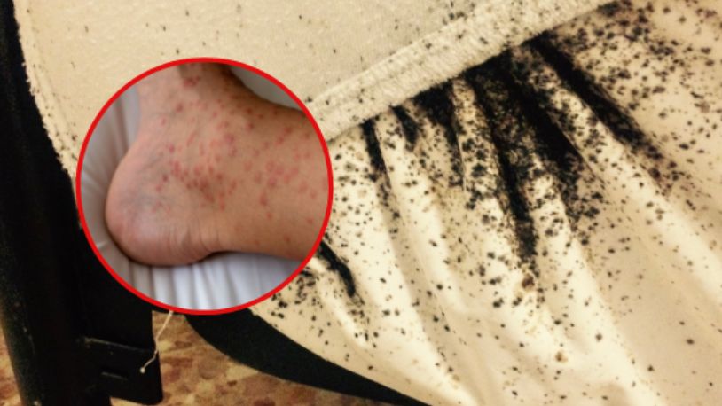 Olsztyn. 8-latka cały czas się drapała. Powodem były insekty