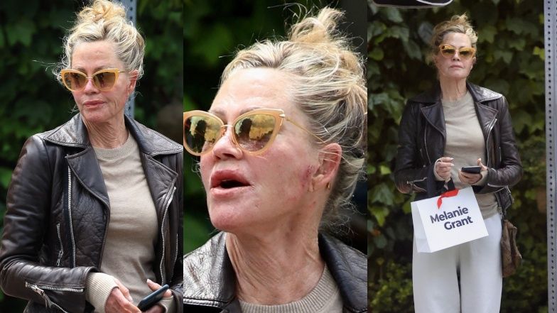Melanie Griffith ze zranieniami twarzy
