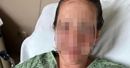 Pokazała twarz po ataku wydry. "Nie sądziłam, że uda mi się wydostać z tej rzeki"