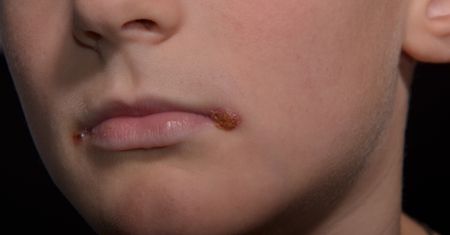 Co na zajady – przyczyny powstawania zajadów, witamina B i C, drożdże, czosnek, aloes, miód, woda z octem i pasta do zębów