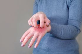 Uczulenie na hybrydę – przyczyny, objawy i leczenie