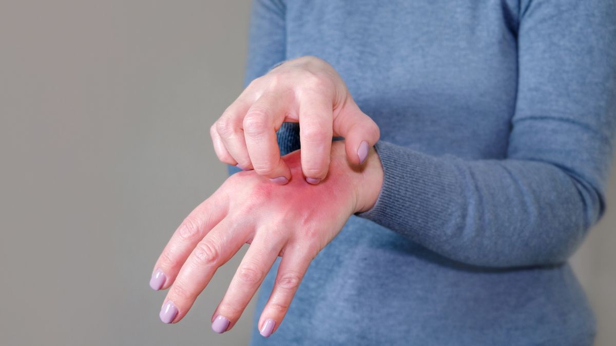 Uczulenie na hybrydę objawia się rumieniem i pęcherzykami