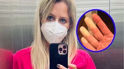 Objaw Raynauda najczęściej pojawia się na dłoniach. Może zwiastować raka