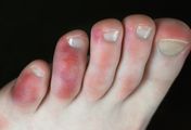 Palce covidowe - przyczyny, objawy, diagnostyka, leczenie