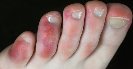Palce covidowe - przyczyny, objawy, diagnostyka, leczenie
