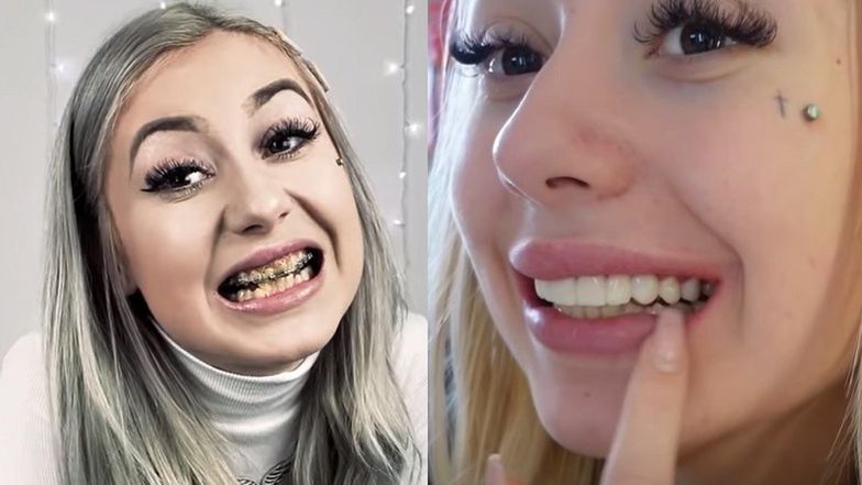 Kinia Wiczyńska narzeka na nowe zęby