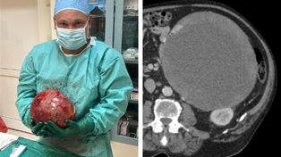 Z brzucha 70-latka usunięto guz ważący aż 5 kilogramów. Spektakularna operacja zakończyła się sukcesem!