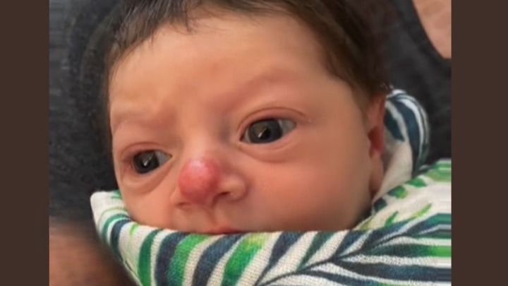 Dziewczynka urodziła się z "nosem klauna". Mimo obaw rodziców znamię w niczym jej nie przeszkadza