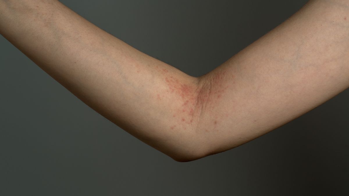 allergy ill skin on handallergy ill skin on hand-aniaostudio-Allergy, Atopic, Atopic Dermatitis, Condition, Dental Assistant, Dermatitis, Dermatology, Eczema, Female, Flexibility, Healthcare And Medicine, Human Hand, Human Neck, Human Skin, Illness, Immunology, Inflammation, Medical Exam, Medicine, Messy, Pain, Patient, People, Physical Injury, Pimple, Pink, Psoriasis, Red, Scratching, Skin Condition, Spotted, Toxic Substance, Toxicodermatitis, Ugliness, Unwell, White Background, Women, dermal, dermatological, skin disease, symptom