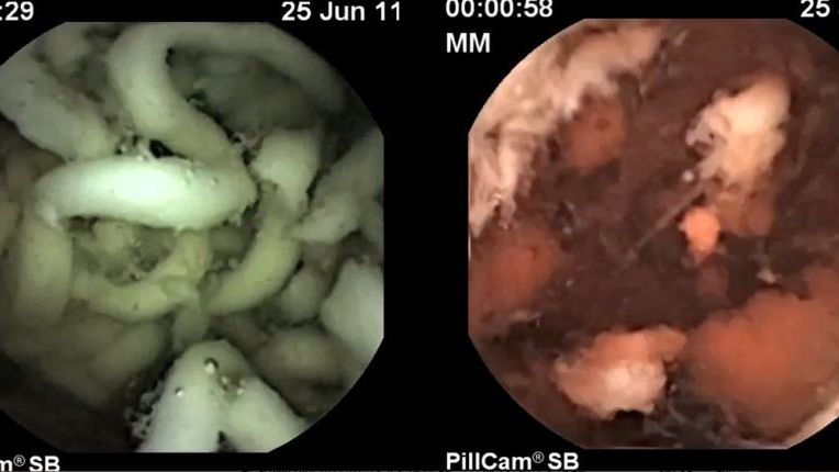 Projekt M2A™- wideopodróż przez cały przewód pokarmowy [wideo] 1
