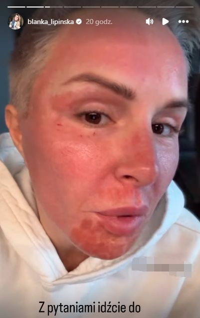 Blanka Lipińska poddała się kolejnemu zabiegowi