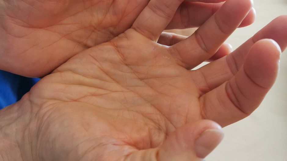 Taki palec może zwiastować cukrzycę