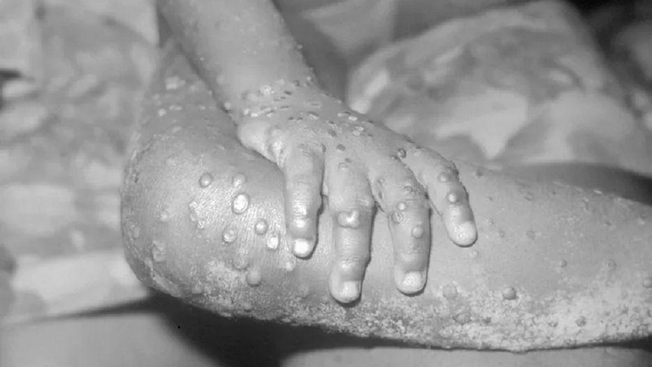 WHO: Najnowsza fala małpiej ospy rozprzestrzenia się drogą płciową.Źródło: GETTY, fot: Smith Collection/Gado