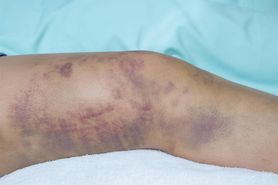 Na ciele 14-latki pojawiły się siniaki. Okazało się, że to objaw białaczki (WIDEO)